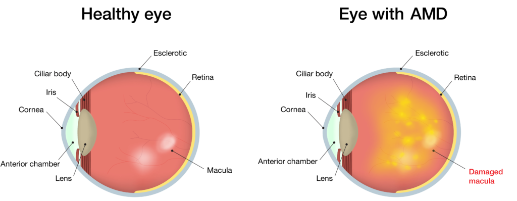 Chart Showing a Healthy Eye Compared to One With AMD