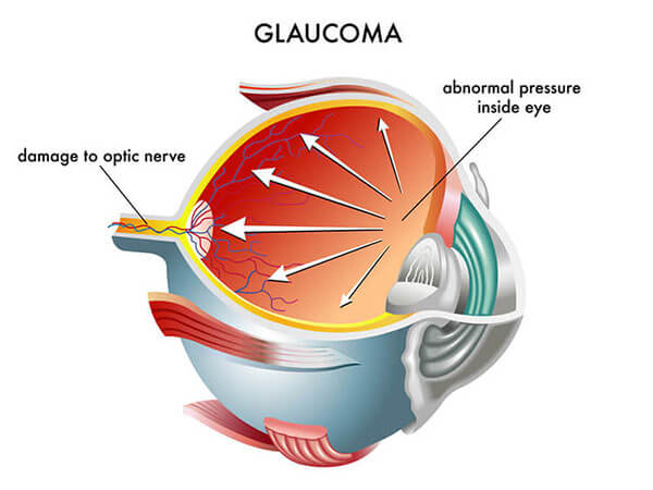 Glaucoma Surgery