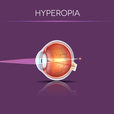 Chart Showing How Hyperopia Affects an Eye