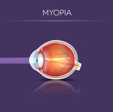 Chart Showing How Myopia Affects an Eye