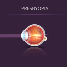 Chart Showing How Presbyopia Affects an Eye
