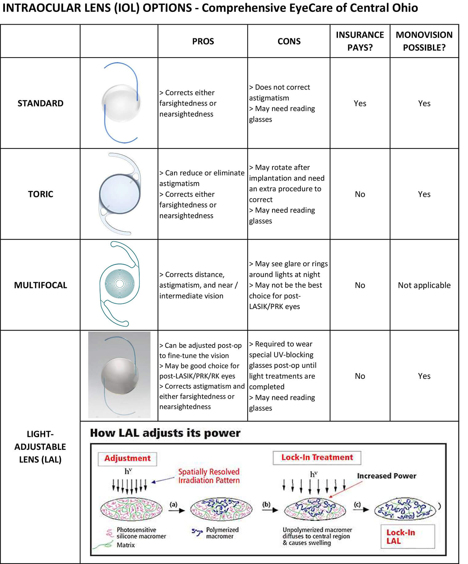 Intraocular Lens Options Chart