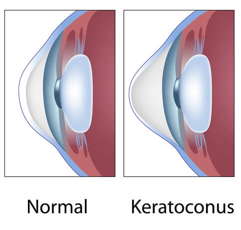 Chart Showing a Normal Eye Compared to One With Keratoconus